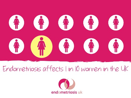 Endometriosis affects 1 in 10 women in the UK treatment of endometriosis